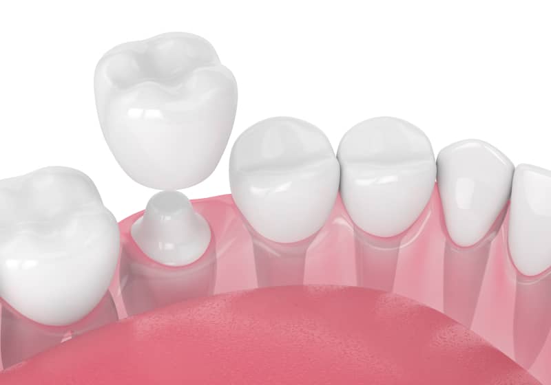 Why Opt for Porcelain Crowns