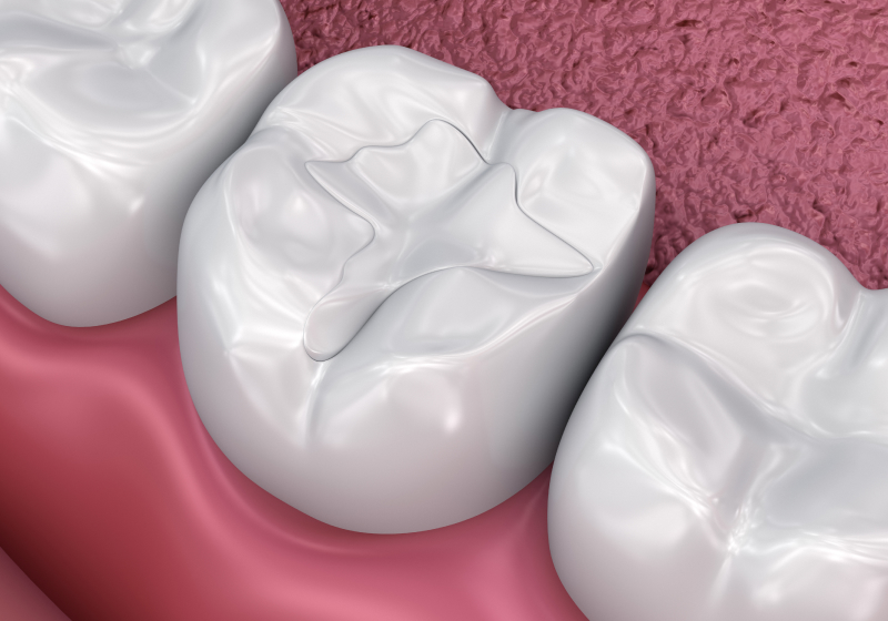 Why Embrace Tooth-Colored Fillings